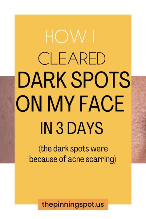 Do you know what it really take to lighten dark spots on your face? Find out in this comprehensive guide the best products & skin tips to effectively clear hyperpigmentation & acne marks. You'll find the secrets to fading acne marks naturally that cause dark spots on your face so as to achieve a flawless complexion in just three days. It's a proven 3-day routine to diminish dark spots on your face naturally, packed with skin tips and product recommendations to achieve a flawless complexion Dark Spot Corrector Diy, Face Dark Spots Remedies, How To Get Rid Of Age Spots On Face, Fading Dark Spots On Face, Remedies For Dark Spots On Face, How To Fade Dark Spots On Face, Dark Marks On Face How To Get Rid Of, Acne Dark Spots Remedies, How To Clear Dark Spots On Face