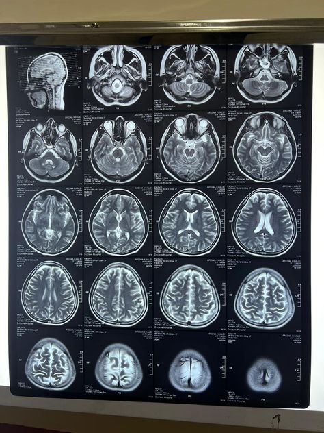 Mri Technologist, Brain Problems, Mri Brain, Stay Rad, Medical Engineering, Case Presentation, Short Notes, Tech Aesthetic, Literature Review