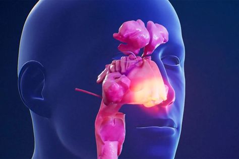 What causes sinuses to become inflamed and infected? And what helps you breathe better? Silent Sinus Syndrome, Swollen Sinus Remedies, Natural Ways To Get Rid Of Sinus Infection, Treat Sinus Infection, Swollen Sinuses, Sinus Polyps, Unblock Sinuses, Sinus Infection Pregnant, Sinus Inflammation