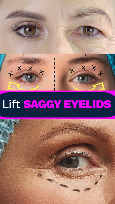 Droopy Eyelids Remedy, Eye Lid Lift Droopy Eyelids, Tighten Eyelids, Saggy Eyes, Saggy Eyelids, Dark Spots Under Eyes, Droopy Eyelids, Eyelid Lift, Beauty Expert