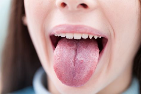 Gluten's Effect on Canker Sores, Cold Sores and Geographic Tongue - Good For You Gluten Free Burnt Tongue, Burning Tongue, Tongue Sores, Celiac Symptoms, Yeast Overgrowth, Canker Sore, Tongue Health, Best Teeth Whitening, Cold Sore