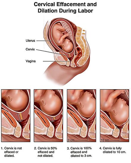 Bishop Score, Cervical Effacement, Dilation And Effacement, Phases Of Labor, Labor Doula, Birth Education, Stages Of Labor, Pregnancy Labor, Childbirth Education