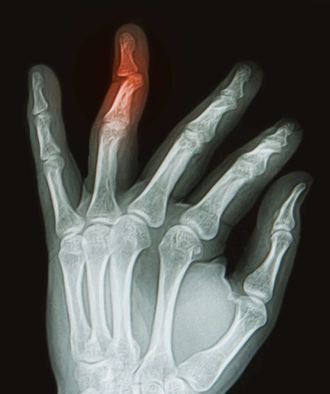 X-ray of hand with broken ring finger Broken Finger, Xray Art, Asthetic Picture White And Black, Pictures Of Plants, Young Farmers, Imperial College London, Different Kinds Of Art, Meaningful Drawings, Cute Inspirational Quotes