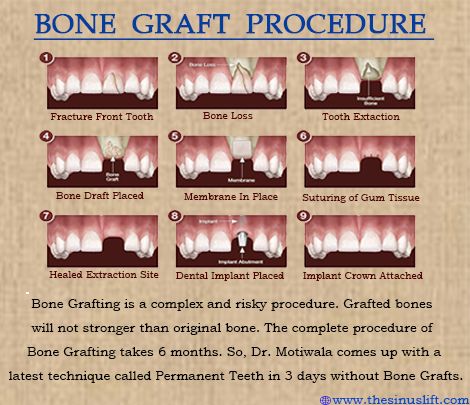 #Dental Bone Graft #Bone Grafting is a surgical system that replaces lacking bone to be able to restore bonefractures which are extremely complex, pose a big health hazard to the sufferer (or) fail to heal properly. #Dr.Motiwala comes up with a new technique called Permanent Teeth within three days without bone grafting procedures. http://thesinuslift.com/bonegrafting.php Bone Grafting Teeth, Affordable Dentures, Bone Grafting, Bone Collector, Implant Dentistry, Front Teeth, Bone Loss, Tooth Extraction, Bone Density