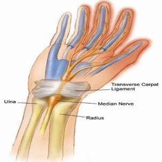 5 Powerful Herbal Remedies For Carpal Tunnel - How To Treat Carpal Tunnel Syndrome Naturally | Natural Home Remedies Carpel Tunnel Syndrome, Carpel Tunnel, Median Nerve, Senior Health, Carpal Tunnel, Alternative Health, Natural Home Remedies, Health Info, Health And Beauty Tips