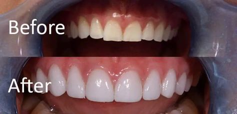 Veneers vs. dental crowns: Comparison and how to choose the best option for you Porcelain Crowns, Tooth Crown, Dental Bonding, Veneers Teeth, Burbank California, Porcelain Veneers, Dental Veneers, Dental Crowns, Stained Teeth