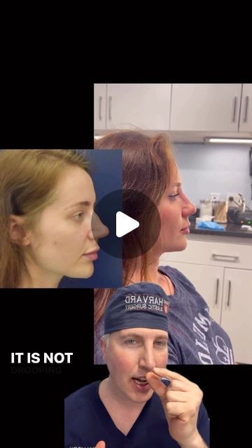 Dr. Richard Reish, M.D., FACS on Instagram: "Rhinoplasty:  1.5 years post-op. Nasal tip deprojection is a powerful and critical maneuver to perform in a patient with an over-projected and elongated tip 👍.  .  Please feel free to contact my office for a complimentary  consultation at 212-879-8506. . .  My personal Bio, full gallery of before and after pictures, and a list of procedures I perform can be found at the link on my Instagram homepage. . .  This is my actual patient with real results who has given informed consent to appear on my website and social media pages. . .  #plasticsurgery #boardcertifiedplasticsurgeon #plasticsurgeon #rhinoplasty #rhinoplastydiary #realself #cosmeticsurgery #rhinoplastybeforeandafter #rhinoplastyspecialist #nosejob #nosejobcheck #nosejobbeforeandafter" Nasal Tip Rhinoplasty, Rhinoplasty Swelling Progression, Revision Rhinoplasty Before After, Rhinoplasty Before After, Personal Bio, Rhinoplasty Before And After, Informed Consent, Post Op, After Pictures