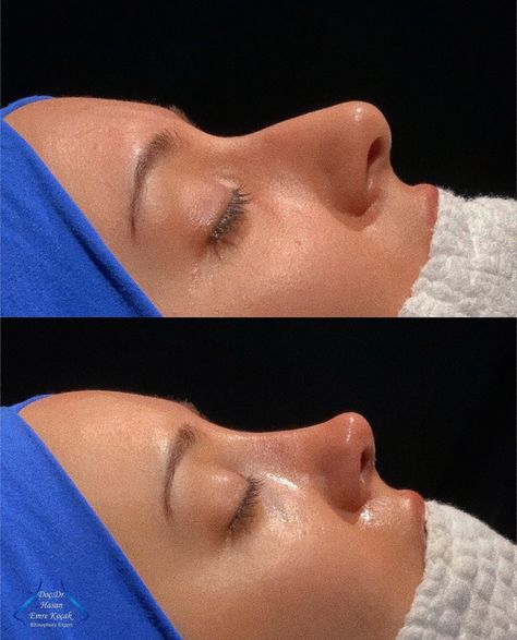 Ski Slope Nose Job, Cindy Nose Job, Nose Job Straight, Nose Job Inspiration Side Profile, Nose Jobs Inspiration, Natural Looking Nose Job, Nose Job Aesthetic Cast, Nose Job Transformation, Big Nose Rhinoplasty