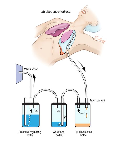 Chest Tubes Nursing Cheat Sheet, Chest Tube, Nursing School Motivation, Basic Anatomy And Physiology, Nursing Student Tips, Medical Student Study, Pulmonology, Nursing School Survival, Critical Care Nursing