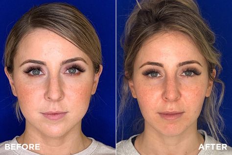 Cheek Fat, Sagging Cheeks, Cheek Fillers, Lifting Facial, Reduction Surgery, Slimmer Face, Facial Plastic, Facial Exercises, Chubby Cheeks