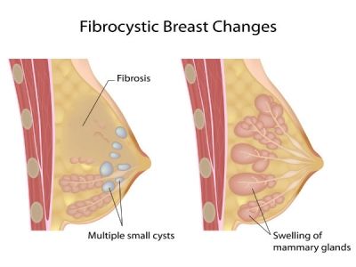 Stuffy Nose Remedy, Low Estrogen Symptoms, Inflammation Recipes, Anti Inflammation Recipes, Mammary Gland, Too Much Estrogen, Low Estrogen, Stuffy Nose, Cold Cough