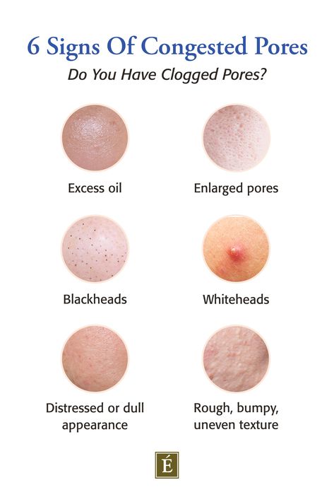 Graphic showing 6 types of clogged pores, including excess oil, enlarged pores, blackheads, whiteheads, distressed or dull appearance and rough, bumpy, uneven texture. Congested Pores Skincare, Congested Pores, Eminence Organic Skin Care, Rid Of Blackheads, Beauty App, Congested Skin, Good Skin Tips, Beauty And Skincare, Get Rid Of Blackheads