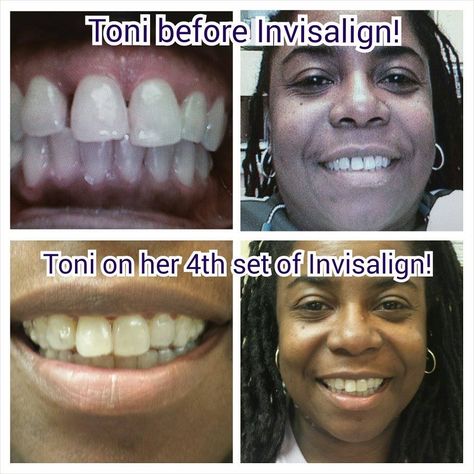 Teri is making progress with her Invisalign #smile #dentalcare Oral Health, Beautiful Smile, Dental Care