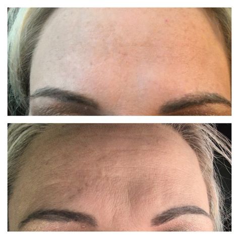 Dermarolling Before and After Pics - Dermarolling for Scars and Acne Dermarolling Before And After, Skin Needling Before And After, Dermaroller Before And After, Dermapen Before And After, Rf Microneedling Before And After, Dermabrasion Before And After, Micro Needling Before And After, Microneedling Before And After, Derma Roller Before And After