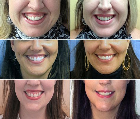 Bothered by a 'Gummy Smile' --- Botox is increasingly being used to correct a "gummy smile" Gummy Smile Correction, Botox Forehead, Teeth Aesthetic, Gum Surgery, Botox Before And After, Botox Lips, Muscles Of The Face, Gummy Smile, Botox Fillers