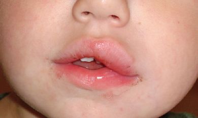 swollen lip Sores In Mouth Remedies, Mouth Sore Remedy Kids, Swollen Lips After Kiss, Ulcer Remedies Mouth, Nose Allergy, Mouth Ulcer, Swollen Lips, Prediabetic Diet, Strep Throat