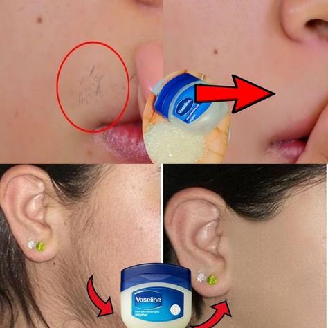 Remove Facial Hair Permanently, Upper Lip Hair Removal, Vaseline Original, Lip Hair Removal, Upper Lip Hair, Lip Hair, Hair Removal Cream, Upper Lip, Facial Hair