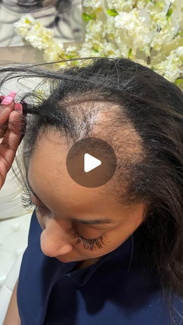 Cherie Amor on Instagram: "My client said Cherie I don’t want a perfect ponytail, I want it to look like it’s mines … She has Areata Alopecia which is an autoimmune condition that causes hair loss. It occurs when the immune system mistakenly attacks the hair follicles, leading to hair loss in small, round patches on the scalp or other areas of the body. Areata alopecia can affect people of all ages and genders, and the exact cause is unknown.  As you can see she has a head full of hair, I gave her a silk press so the frontal piece can blend in extremely well with her hair which it did perfectly. She has absolutely no pieces added to her ponytail and it’s giving very much it’s all her hair from the hair line to the  very end of her ponytail ❤️  We didn’t wanna go for the perfect sleek ponyt Ponytail With Closure, Quick Weave For Alopecia, Bald Spot Hairstyles For Women, Alopecia Ponytail Hairstyles, Hairstyles For Black Women With Alopecia, Hairstyles For Alopecia For Women, See In Closure, Hairstyles For Small Heads, Traction Alopecia Hairstyles