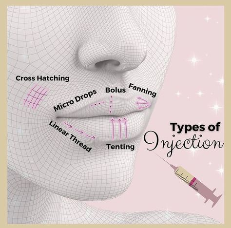 Pin on Lips Vascular Occlusion Filler, Lip Injection Techniques, Injector Aesthetic, Aesthetic Nurse Injector, Face Injections, Dermal Fillers Lips, Facial Injections, Cosmetic Fillers, Aesthetic Nurse