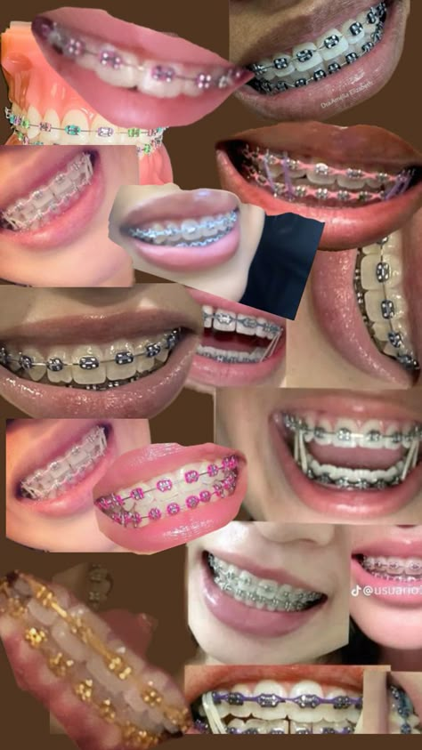 Braces Straight Teeth, Braces Black Color, Baddie Braces Colors, Black Braces Aesthetic, Brace Face Baddie, Black Braces Teeth, Braces Pink, Navy Blue Braces, Perfect Teeth Braces