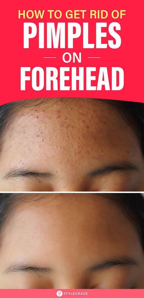 #NaturalRemediesForCold Forehead Bumps, Pimples On Forehead, Get Rid Of Pimples, Blind Pimple, Rid Of Pimples, Forehead Acne, Pimples Under The Skin, Pimples Overnight, Acne Overnight