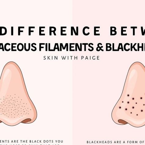 PAIGE QUERNEY • THE SKIN BAR on Instagram: "The difference between sebaceous filaments & blackheads 👀  I have clients ALL the time come in & think their blackheads are “so bad”, when in reality it’s actually sebaceous filaments.  So let’s break it down…  Do you have sebaceous filaments or blackheads?  theskinbar.ca" Sebaceous Filaments, Skin Bar, Blackheads, Let It Be, Bar, Skin, On Instagram, Beauty, Quick Saves