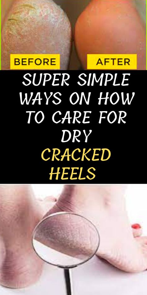 Dry Heel Remedies, Cracked Feet Remedies, Soften Heels, Cracked Heel Remedies, Heal Cracked Heels, Dry Cracked Heels, Dry Heels, Thick Moisturizer, Rough Heels