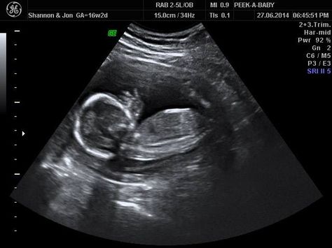 Baby scan photo somewhere 3rd Month Pregnancy, Scan Photos, Baby Scan Photos, Eid Pics, Baby Scan, Prenatal Care, Baby Growth, Chasing Dreams, Pregnancy Health