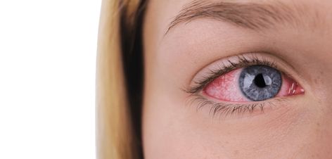 Can I Make a Broken Blood Vessel in My Eye Go Away Faster? Blood Vessel In Eye, Sunken Eyes, Dry Eye Symptoms, Eye Facts, Eye Meaning, Dry Eye, Pink Eye, Eye Drops, Dry Eyes