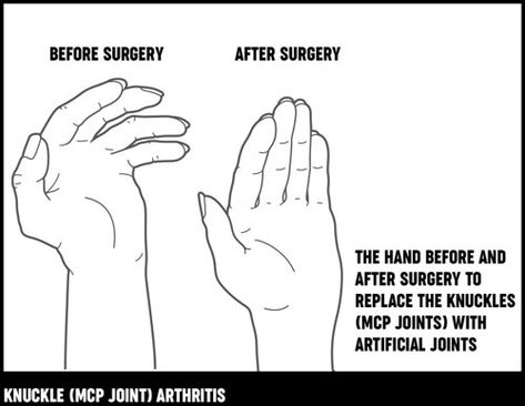 Inflammation Remedies, Preparing For Surgery, Trigger Finger, Types Of Hands, Carpal Tunnel, Scar Tissue, After Surgery, The Common, Surgery