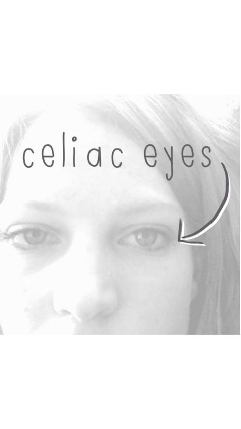 What+I+want+you+to+know+about+celiac+disease+-+inspiredrd.com Celiac Eyes, Celiac Diet, Kitchen Checklist, Gluten Free Meals, Comfort Casseroles, Going Gluten Free, Gluten Free Dishes, Gluten Free Recipes For Dinner, Genetic Testing