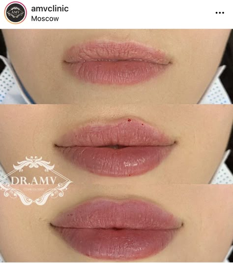 Dermal Fillers Lips, Lips Inspiration, Lip Types, Botox Lips, Facial Fillers, Facial Contouring, Facial Aesthetics, Crazy Ideas, Photos Of People