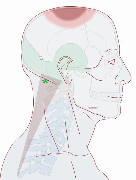 Headache on the Top of Your Head - Integrative Works Headache Top Of Head, Headache Meaning, Cervicogenic Headache, Anatomy Notes, Forward Head Posture Exercises, Relieve Neck Pain, Dairy Free Breastfeeding, Neck And Shoulder Muscles, I Have A Headache