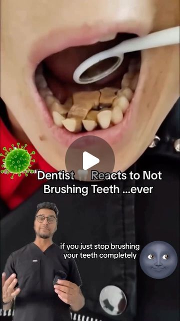 Dentistry on Instagram: "Post by • @dentite313 This a rare case of never brushing your teeth 🦷 why this occurs, bacteria 🦠 will overtake the mouth . And it will “derode “ the teeth , bone and gums. Meant to say deteriorate but derode stuck in my head 🤣" Eye Surgery Humor, Tartar Removal From Teeth, Teeth Tartar Removal, Teeth Bonding, Surgery Humor, Rotten Teeth, Teeth Diseases, Tartar Teeth, Plaque Teeth