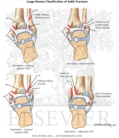 Ankle Rehab Exercises, Ankle Rehab, Ankle Fracture, Rehab Exercises, Ankle Injury