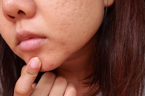 Tretinoin Before And After, How To Treat Blackheads, What Are Blackheads, Treating Cystic Acne, Sebaceous Filaments, Post Inflammatory Hyperpigmentation, Cosmetic Dermatology, Types Of Acne, Skin Resurfacing