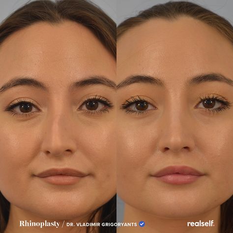 Nose Job Front Profile, Crooked Nose Front View, Crooked Nose Contouring, Straight Nose Front View, Nose Job Inspo Front View, Subtle Nose Job, Rhinoplasty Front View, Nose Job Front View, Best Nose Jobs