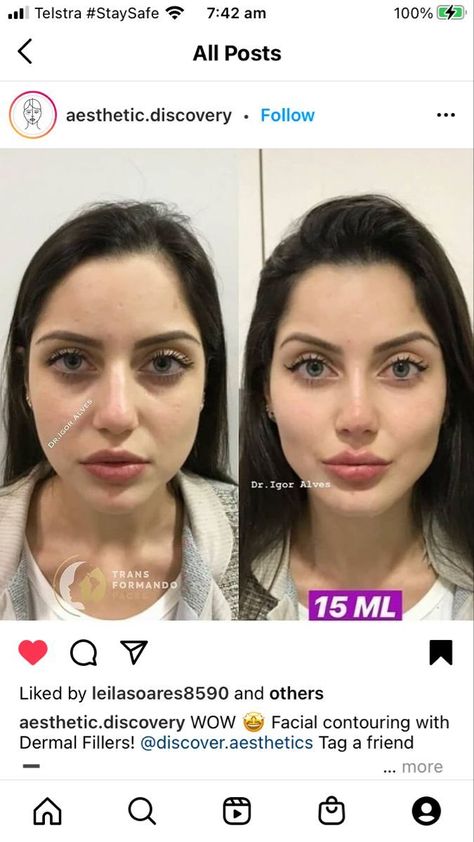 Rhinoplasty Nose Jobs, Face Fillers, Botox Lips, Cheek Fillers, Beauty Procedures, Facial Fillers, Facial Contouring, Facial Aesthetics, Celebrity Plastic Surgery