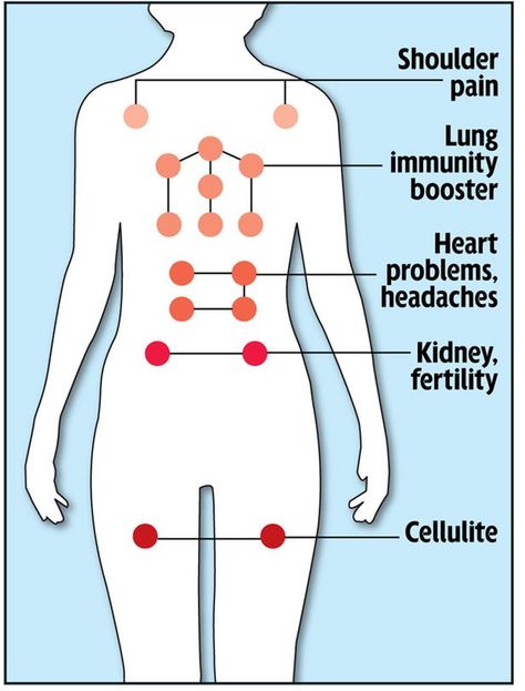 Hijama Points, Cupping Points, Chinese Cupping, Acupuncture Benefits, Cupping Massage, Cupping Therapy, Acupuncture Points, Acupressure Points, Chronic Condition