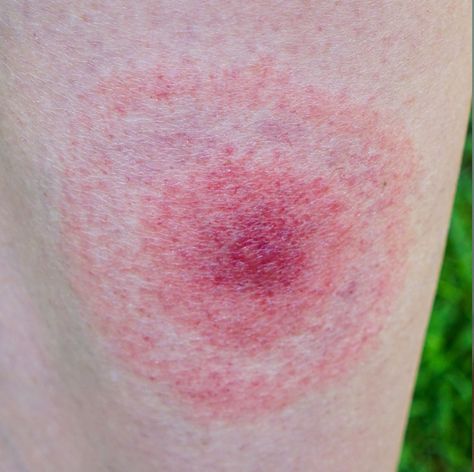 From ticks to spiders to bed bugs, they’re all pretty gnarly. Brown Recluse Spider Bite Pictures, Spider Bites Remedies, Brown Recluse Spider Bite Stages, Tick Bites On Humans, Deer Tick Bite, Achilles Bursitis, Bed Bug Bites Pictures, Spider Bites Pictures, Recluse Spider Bite