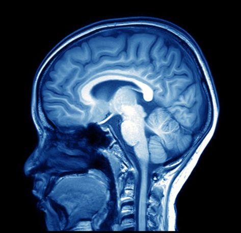 Mri Brain, Types Of Strokes, Brain Images, Frontal Lobe, Brain Scan, Mri Scan, Ct Scan, Magnetic Resonance, Human Brain