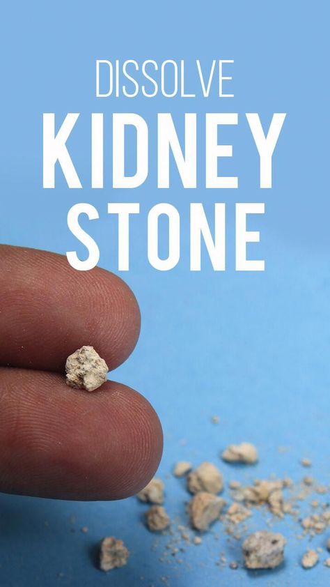 How to Pass Kidney Stones Fast Naturally at Home?Kid Clear capsules are the best herbal pills to pass kidney stones fast at home. These pills remove kidney s... #HealthTips #FitLife #SelfCare #NutritionTips #HealthyLiving #HealthyLifestyle #Wellness #FitnessTips Kidney Stone Pain Relief, Diy Shampoo Recipe, Healthy Liver Diet, Improve Kidney Function, Pain Relief Remedies, Kidney Stone, Liver Diet, Baking Soda Shampoo, Kidney Health