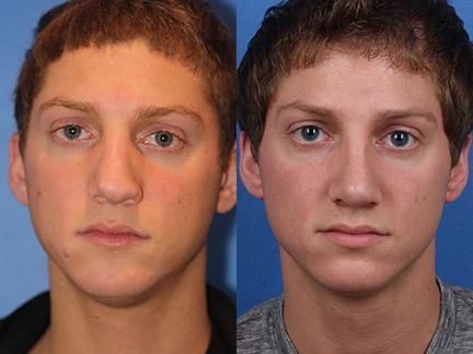 Revision male rhinoplasty before and after Male Nose Job, Rhinoplasty Before And After, Nose Surgery, Nose Job, Surgery, Bridge, New York