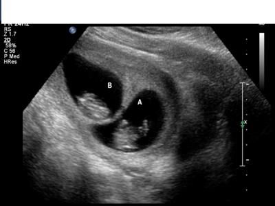 Ultrasound Pictures Twins, Ultrasound Pictures 8 Weeks, 10 Week Ultrasound Pictures, 11 Week Ultrasound, Twin Ultrasound Pictures 8 Weeks, Identical Twins Ultrasound, 10 Week Ultrasound, Twin Ultrasound At 12 Weeks, Twin Ultrasound 6 Weeks