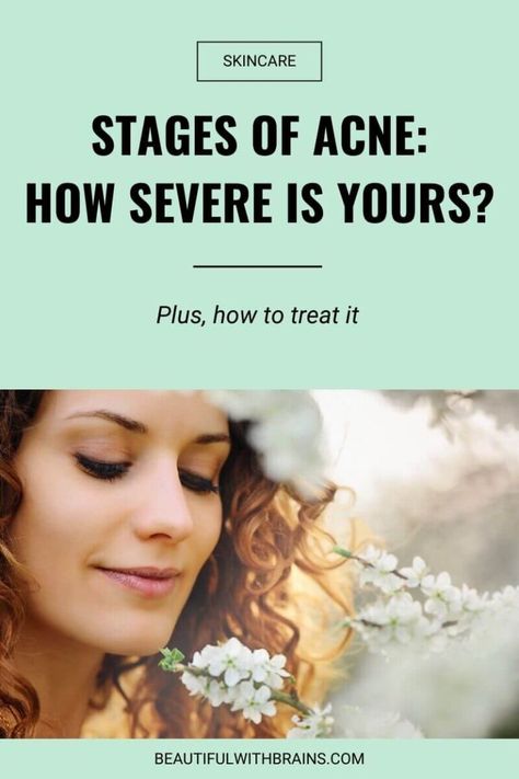 Stages Of Acne: How Severe Is Yours? (Plus, How To Treat It) Back Acne Remedies, Cystic Acne Remedies, Prevent Pimples, Losing 40 Pounds, Natural Acne Remedies, Home Remedy For Cough, How To Get Rid Of Pimples, Natural Sleep Remedies, Natural Cold Remedies