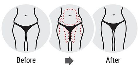 Transforming Your Hips: Before and After Hip Dips | by Ari Mars | Mar, 2023 | Medium What Are Hip Dips, Healthy Holistic Living, Hips Dips, Squat Workout, Fit Girl Motivation, Business Card Modern, Beginner Workout, Fat Removal, Burn Fat Faster