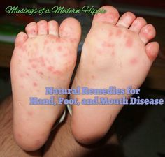 Natural Remedies for Hand, Foot, and Mouth Disease - Musings of a Modern Hippie Hand Foot And Mouth Disease, Itchy Hands, Parker James, Happy Homemaking, Natural Immune Boosters, Sick Remedies, Modern Hippie, Daycare Ideas, Holistic Remedies