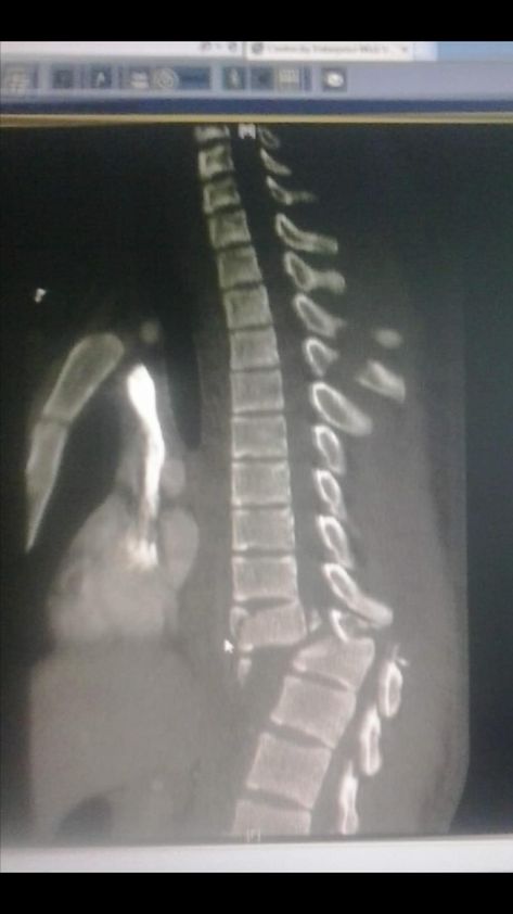 Injury Aesthetic, Mri Scan, Spinal Injury, Peer Support, Space Illustration, Spinal Cord, X Ray