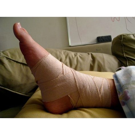 How Long Does a Sprained Ankle Take to Heal? Sprained Ankle Remedies, Ankle Sprain Recovery, Patellar Tendon, Ankle Fracture, Ankle Exercises, Twisted Ankle, Broken Finger, Knock Knees, Ankle Surgery