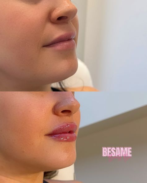 OBSESSED 😍😍😍 She had filler done 6 months ago but wanted more volume, so here we are, a full syringe later 🩵💉 If you’re waiting for a sign, this is it! ✨ Book your next lip filler appointment with me 💕 👩🏻‍⚕️Cindy H. RN, BSN | @beautynurse.cindy 📍Bésame Beauty Bar | 8080 N Central Expy Suite 1250, Dallas, TX 75206 🏥 Concierge Services Available in & around the Forney area 💉 Book using link in bio or DM 💌 DM for free consult #beautyinjector #lipfiller #dermalfillers #fullsyringe #halfsyring... Lip Filler Half Syringe, It Book, Lip Filler, Dermal Fillers, Lip Fillers, Beauty Bar, Dallas Tx, 6 Months, Dallas